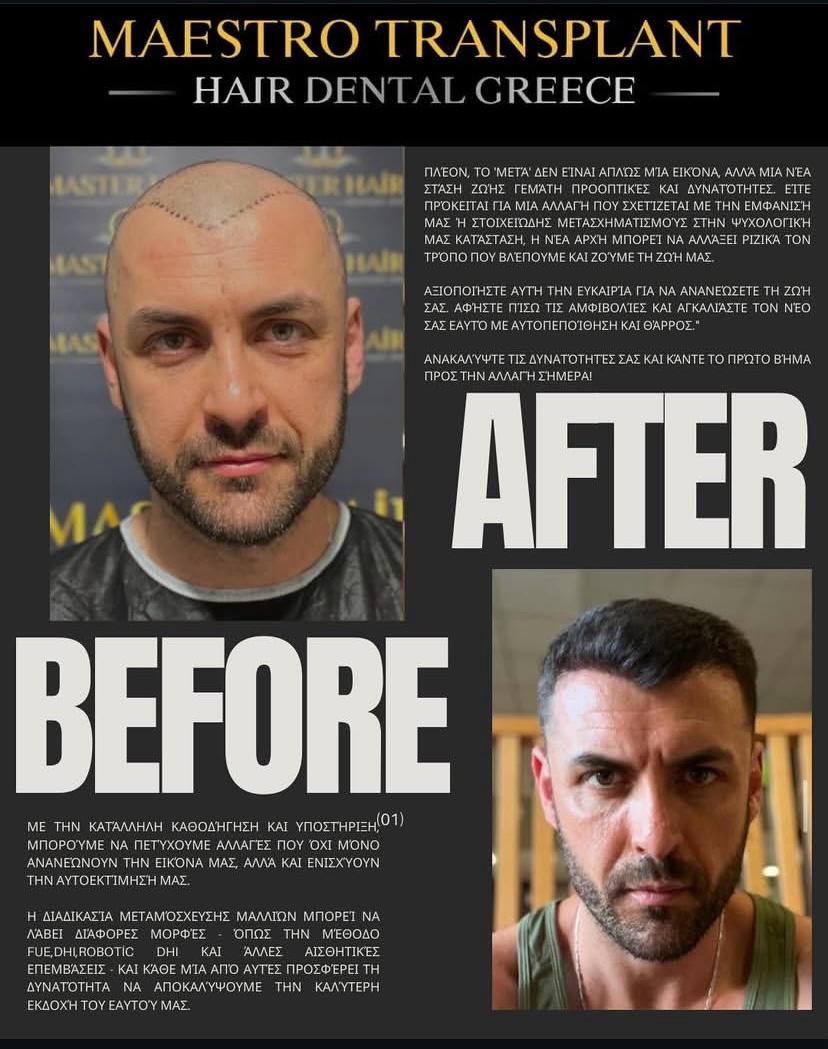 Maestro transplant hair